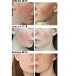 کرم ضدجوش آزلائیک اسید ۲۰٪ اسکینورن | Skinoren 20% Cream Azelaic Acid 30 gr - Image 4